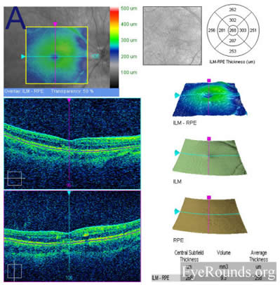 idiopathic recurrent neuroretinitis, leber's stellate neuroretinitis, bartonella henslae, cat-scratch disease, macular star