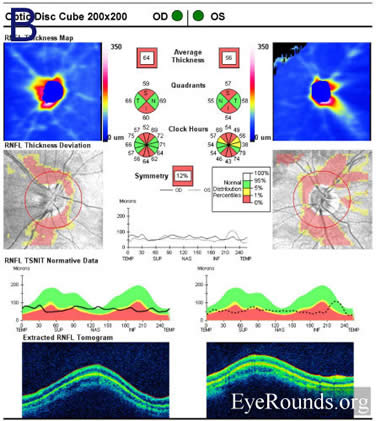 idiopathic recurrent neuroretinitis, leber's stellate neuroretinitis, bartonella henslae, cat-scratch disease, macular star