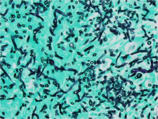 Figure 8. Grocott-Gomori methenamine-silver stain highlighting fungal elements