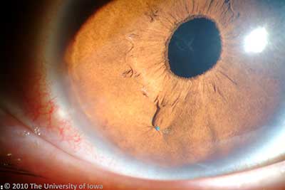 Figure Four:  Note the prolene suture securing the lens to the iris