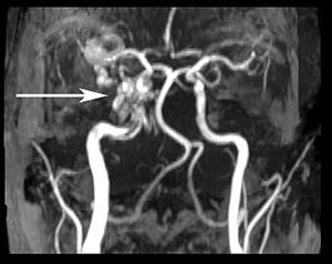 Figure 6: Three dimensional reconstructed image showing the CC fistula (arrow) 