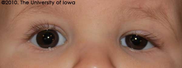   Note that the upper eyelid position has improved and that the eyelid margin is above the visual axis