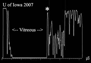 Figure 3B: A-scan reveals low and medium reflectivity of throughout the lesion (posterior to the highly-reflective retinal surface spike indicated by the asterisk *)