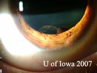 Figure 1A: Slit lamp examination shows cystic and solid components to the lesion. 