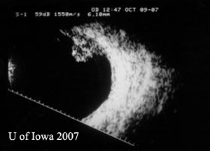 Figure 3A: Standardized B-scan echography of the lesion, OD. 