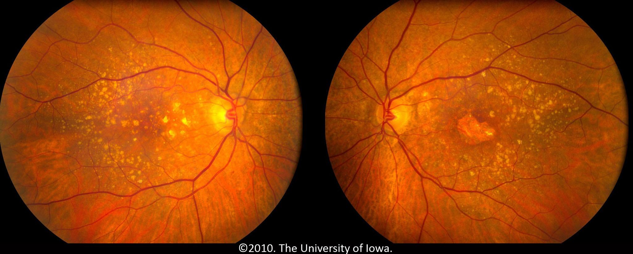 disease progression kin nonmem