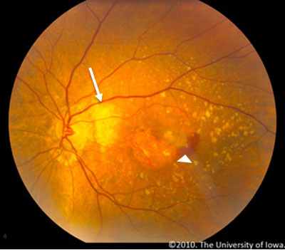 Left eye color fundus