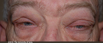 External Photo demonstrating periorbital erythema, mild periorbital edema, and left-sided ptosis