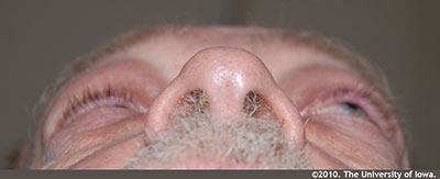 External photograph demonstrating axial proptosis of the left eye