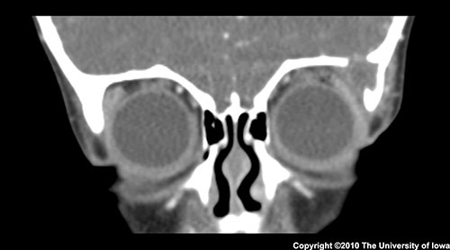 Figure 2. This coronal CT image demonstrates a well-defined osteolytic lesion in the superotemporal aspect of the left orbit. The adjacent bony erosion is particularly well demonstrated with this imaging modality. There are no other lytic lesions. The lesion does not extend into the brain parenchyma.