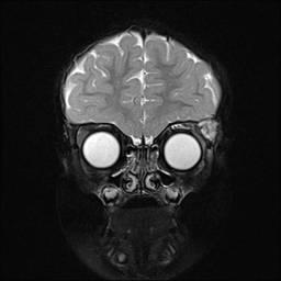 Figure 4. T2 post-contrast coronal MRI image demonstrates an enhancing mass in the superotemporal aspect of the left orbit.