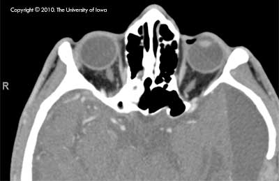 CT scan, axial view confirming the bilateral enophthalmos