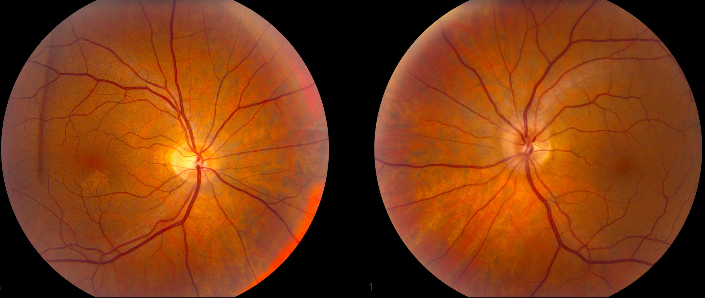 Anca Associated Granulomatous Vasculitis Wegeners Granulomatosis