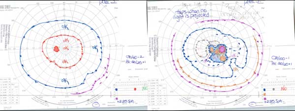 Initial Goldmann visual field showing dense cecocentral scotoma of right eye