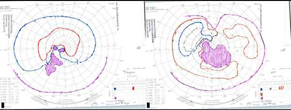 Goldmann visual field before high dose steroids