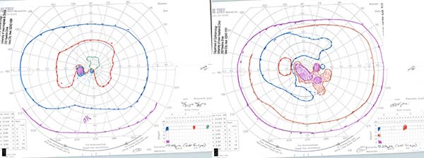 Goldmann visual Field after high dose steroids