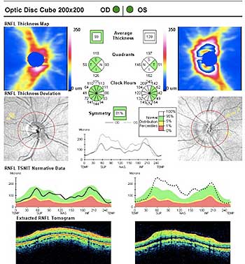 OCT showing NFL in left optic nerve