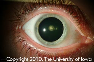 Posterior Polar cataract of the right eye