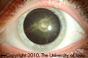 Posterior polar cataract of the left eye 