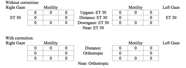 With correction: Motility: Full both eyes;  Orthotropic in the distance and at near