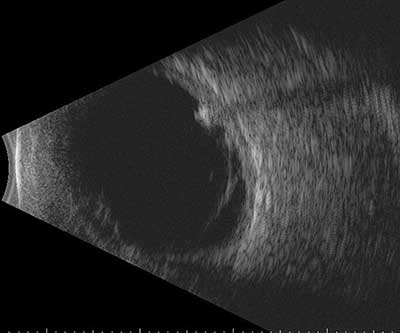 Intraocular Foreign Body, details in caption above.