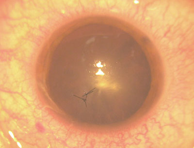 Intraocular Foreign body, caption below