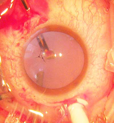 Intraocular Foreign nody, caption below)