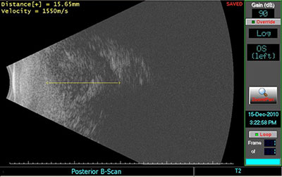 Orbital Ultrasound