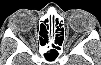 CT scan