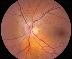 Optic Nerve Photo