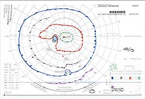 Goldmann Visual Field