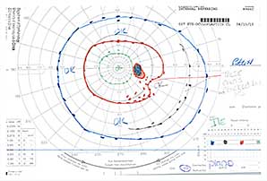 Goldmann Visual Field