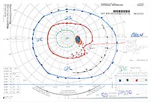 Goldmann Visual Field