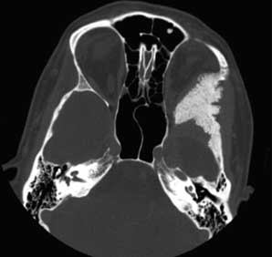 CT Scan