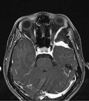 MRI (T1 sequence)