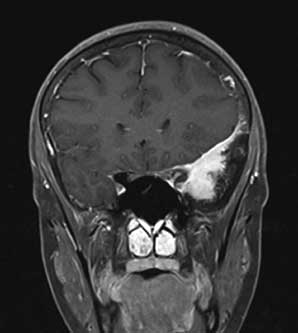 MRI (T1 sequence)