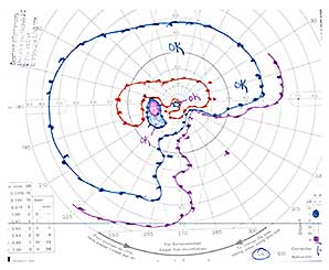 Goldmann Visual Field