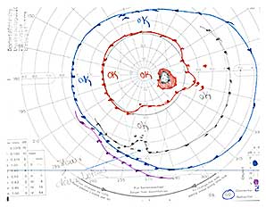 Goldmann Visual Field