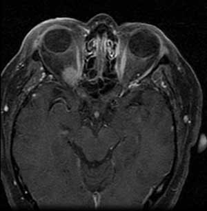 Optic nerve sheath meningioma