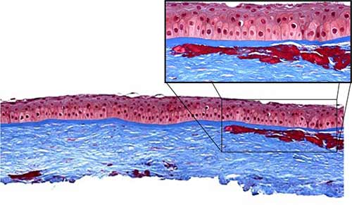 Eosinophilic deposits stain bright red with Masson trichrome stain