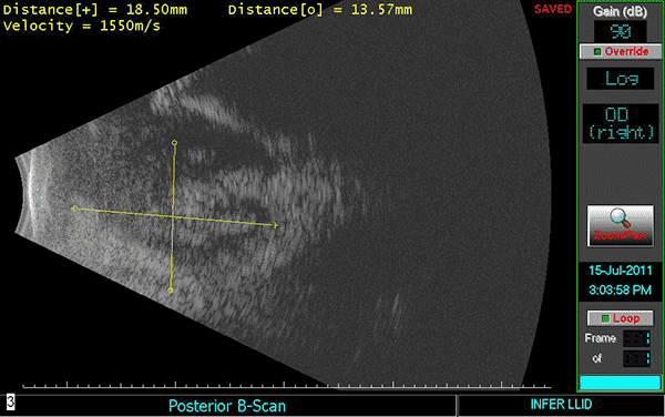 Orbital Ultrasound