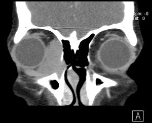 Orbital CT