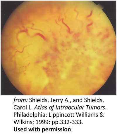 Optic Nerve