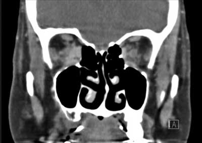 Figure 4.? CT scan demonstrating an ill-defined intraconal lesion of the right orbit. 