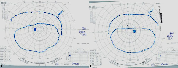 Figure 2 Goldmann Visual Fields