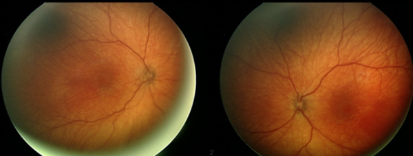 Color fundus photo