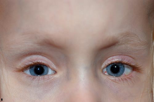 Figure 5: Post-operative photo showing a small residual esotropia and left hypotropia (~7delta).