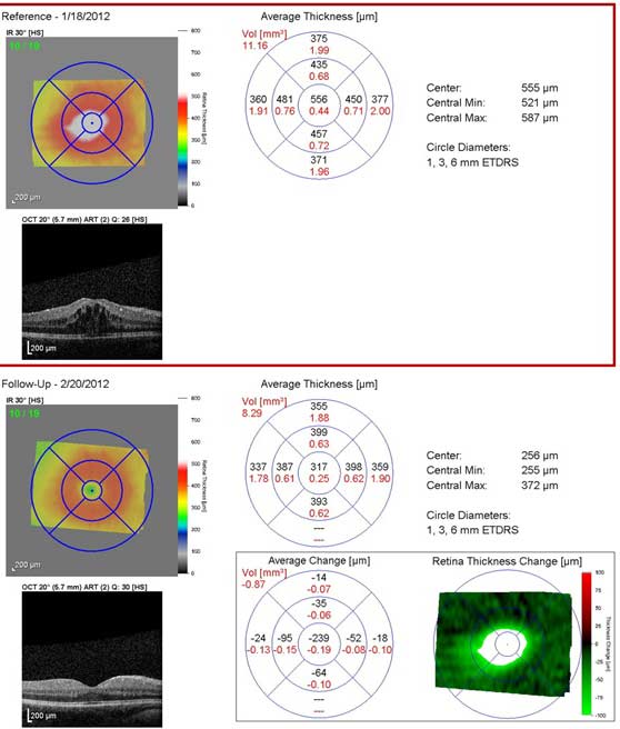 Heidelberg OCT image showing initial OCT with cystoid macular edema (top image) and subsequent resolution of cystoid macular edema (bottom image) in the right eye.