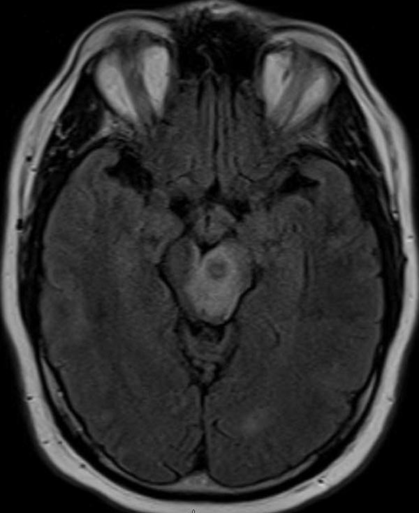 Axial FLAIR, see cpation for details