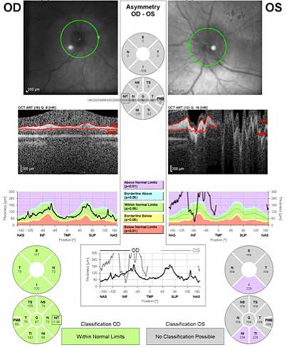 Ocular syphilis